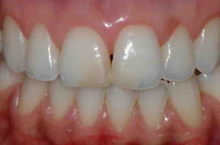 para, de, dentes, anteriores